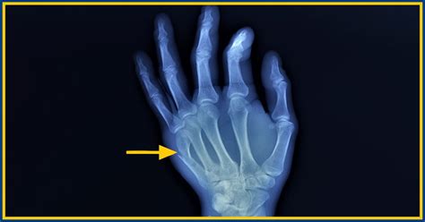 boxer with metal hands|boxer fracture healed incorrectly.